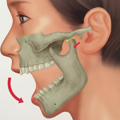 関節 ない 治ら 顎 症