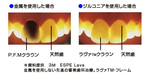 カメラのスポットライト・照明などにあたる方は一目で違いがわかります。